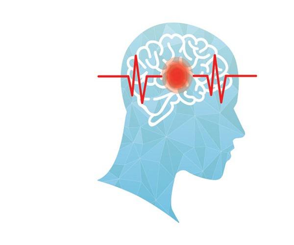 سکته مغزی: نشانه‌ها، علل و راه‌های پیشگیری