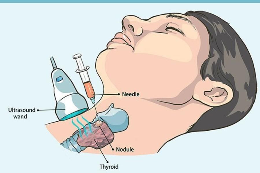 آزمایش FNA تیروئید چیست؟ علائم تشخیص گره و ندول های تیروئید /جزئیات