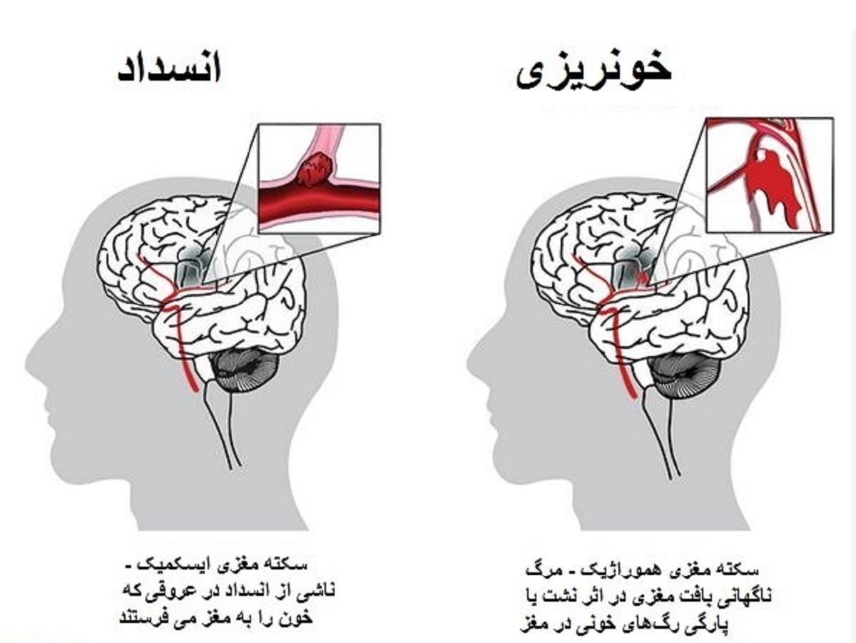 اصلی‌ترین عاملِ خطِر سکته مغزی در همه کشورها یکسان است