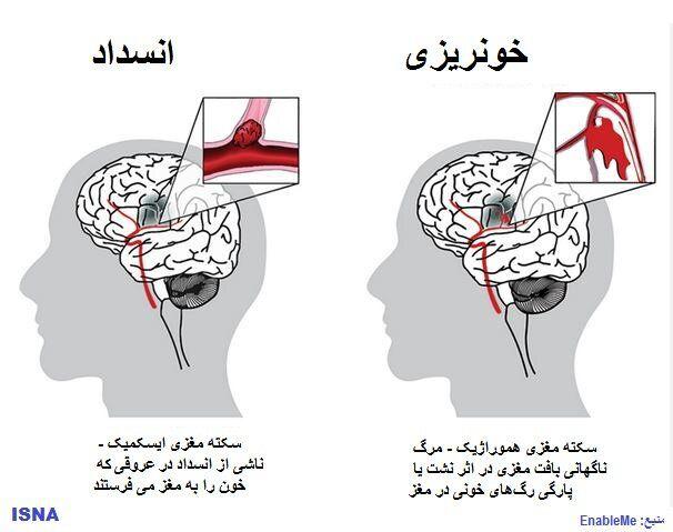 علت افزایش موارد ابتلا به سکته مغزی در جهان چیست؟