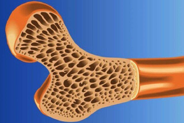 وزارت بهداشت؛ پوکی استخوان در نیمی از جمعیت کشور   خبرگزاری بین المللی