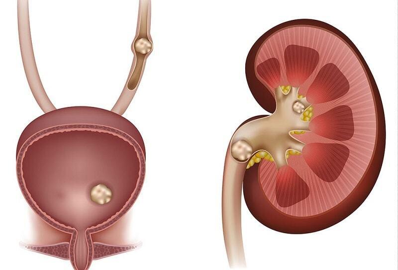 ۶ علامت رایج سنگ کلیه در مردان