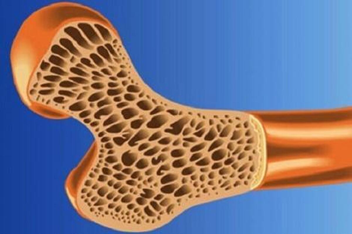 پوکی استخوان در نیمی از جمعیت کشور