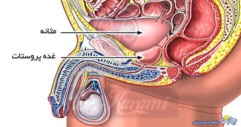 بیماری پروستات چیست و راه‌های درمان آن کدامند؟