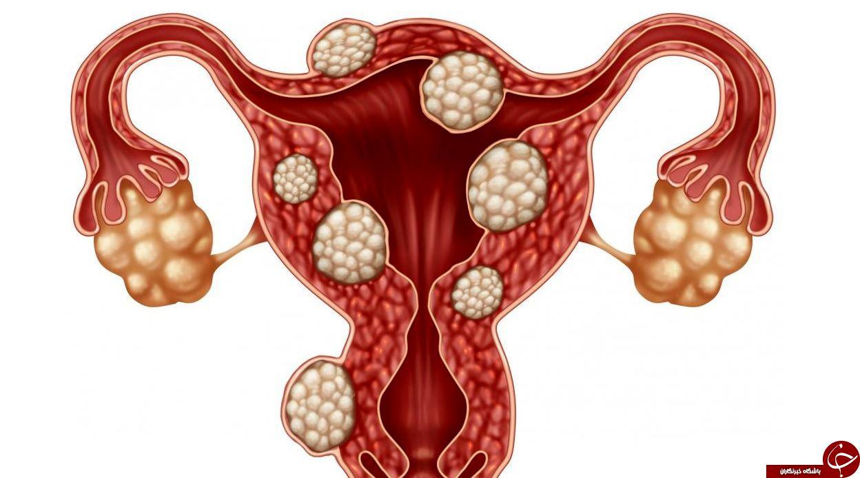 هشدار متخصصان؛ فیبروم رحم را با این روش‌ها درمان نکنید