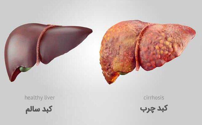 کبد چرب چه علائمی دارد و چگونه درمان می شود؟