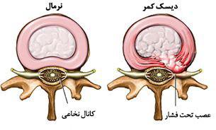 غذاهای مناسب برای دیسک کمر