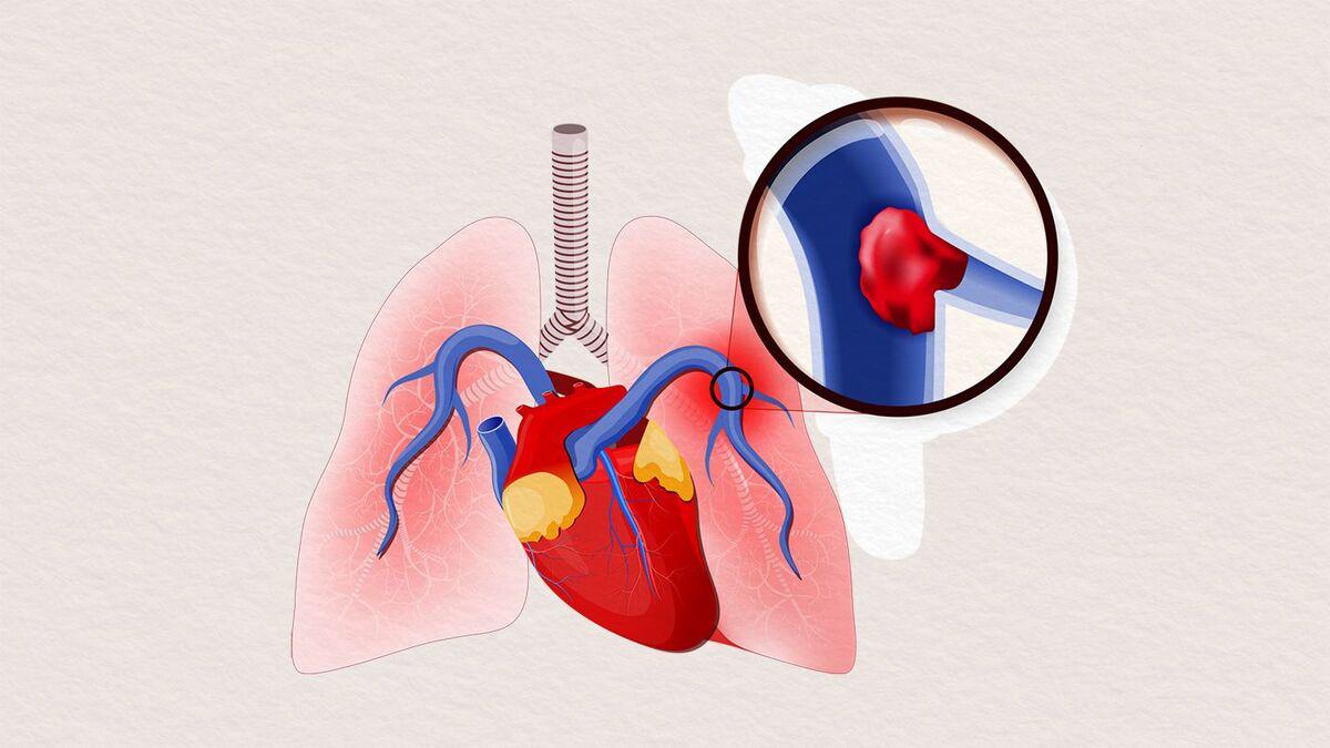 آمبولی ریه چیست؟ نشانه‌های آن را بشناسید + اینفوگرافیک