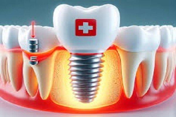 ایمپلنت های دندانی سوئیسیsic یا آلمانی؛ کدام یک بهتر است؟