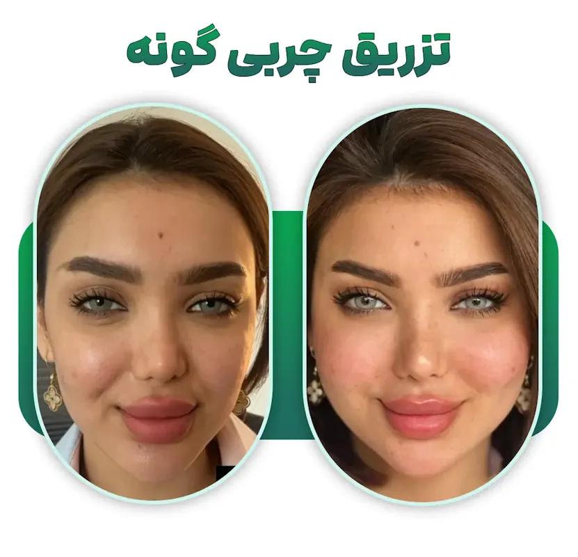 هزینه تزریق چربی صورت چقدر است؟