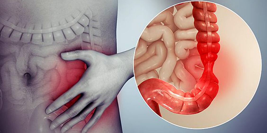 سندروم روده تحریک پذیر چیست؟
