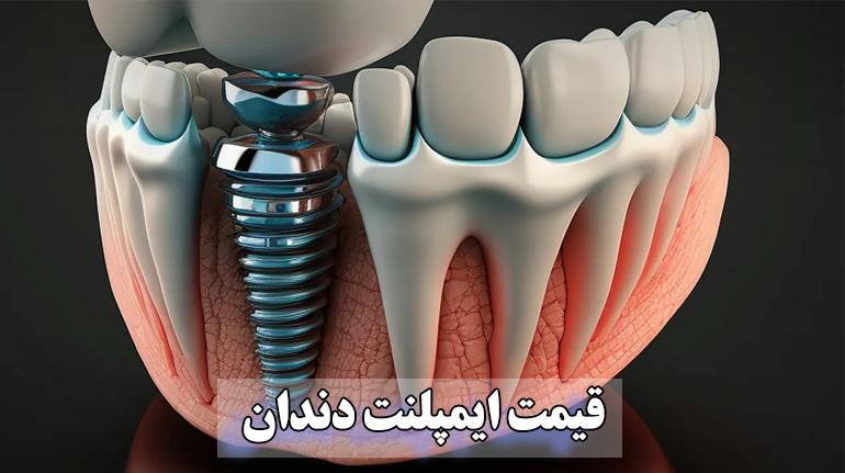 قیمت ایمپلنت دندان (جدیدترین قیمت 1403)   پورتال جامع