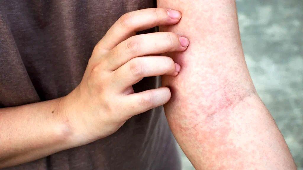 (تصاویر) با انواع بیماری های پوستی خارش دار آشنا شوید؛ از پسوریازیس تا اگزما