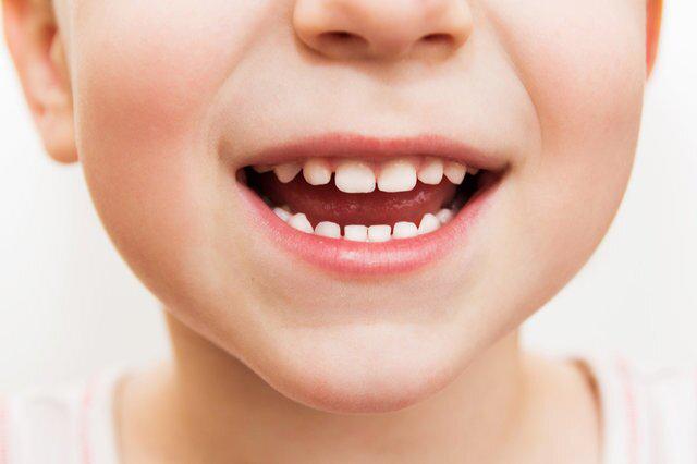 قطره آهن دندان کودک را سیاه می‌کند؛ فریب تبلیغات را نخورید
